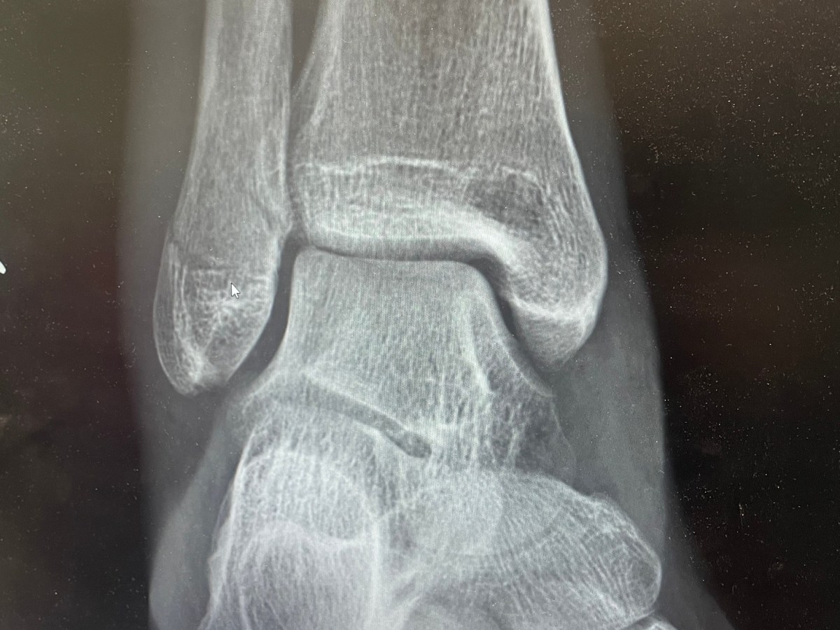 Where I’ve Been – Recovering from a Season Ending Injury,  Lessons Learned, and Looking Ahead
